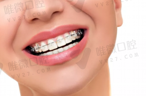金属假牙种类价格区别图,假牙有几种材质？效果和价格怎样(图1)